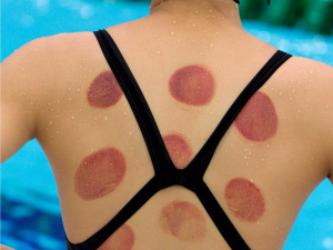 rtr20lze.jpg 300x225 Cupping Therapy